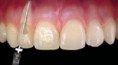 /album/galeria-de-fotos%3a-servi%c3%a7os/endodontia-canal-jpg/